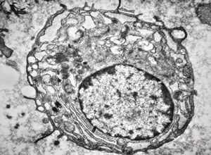 M,64y. | bone marrow - plasmocytoma M,64y. | bone marrow - plasmocytoma